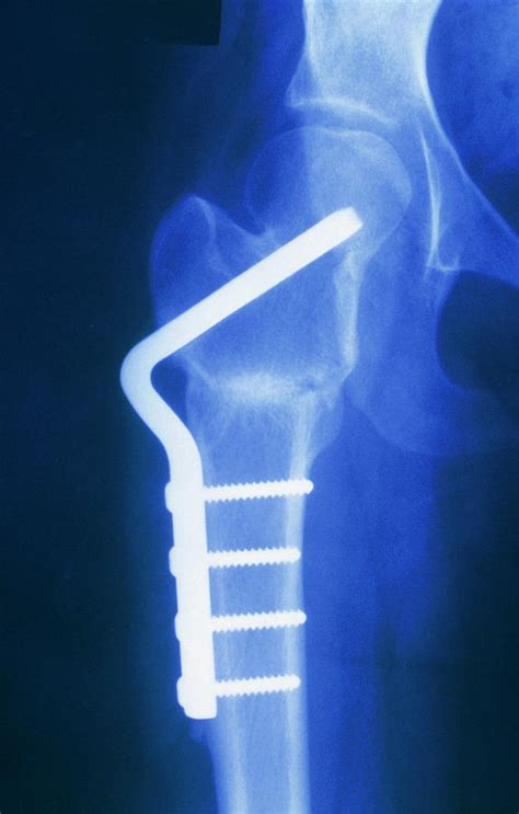 X-ray Of Femoral Osteotomy For Osteoarthritic Hip Photograph by Medical ...