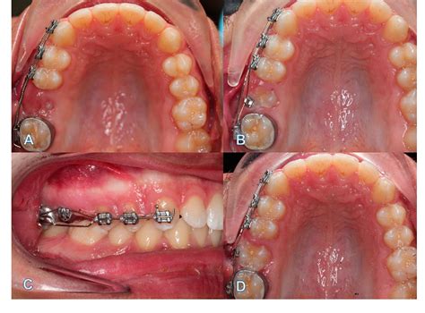 [PDF] Failure of Eruption of First Permanent Molar Teeth: A Diagnostic Challenge | Semantic Scholar