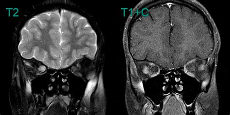 Optic pathway glioma - NEURORADIOLOGY