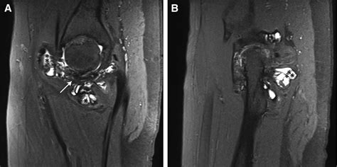 Arthroscopic Treatment Of Pigmented Villonodular Synovitis Of The Hip