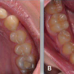 Posterior Oblique Mandibular Occlusal