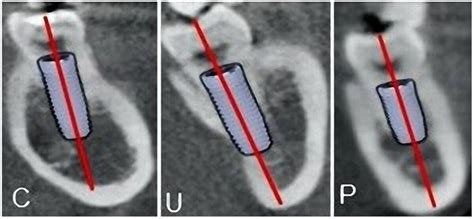 Quantitative And Qualitative 3D Analysis Of Mandibular Lingual