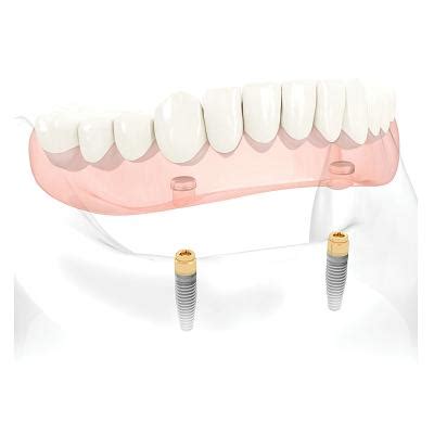 Qué son los pilares Locator para Implantes y para que se utilizan