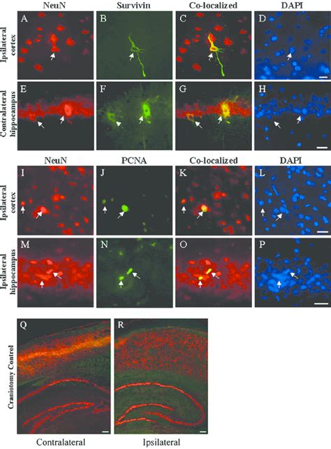 A Sub Set Of Neun Positive Neurons Express Survivin And Pcna After Tbi