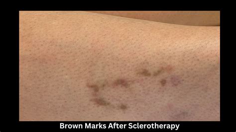 Brown Marks