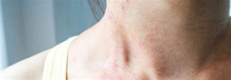symptoms  dengue fever rash   prevention