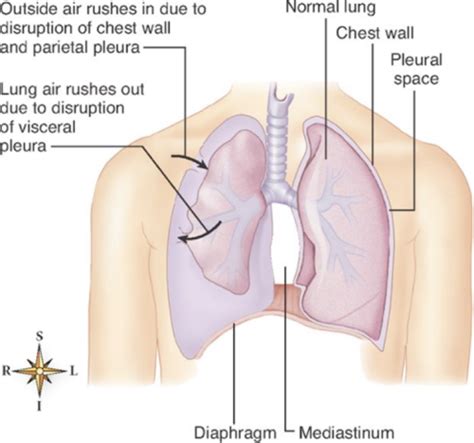 Pneumothorax Hemothorax Flail Chest And Chest Tube Drainage