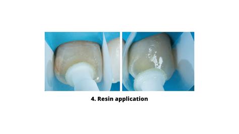 Understanding Icon Resin Infiltration A Comprehensive Guide