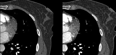 Diagnostic Accuracy Of Pulmonary Ct Angiography At Low Tube Voltage