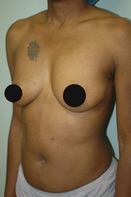 Patient 990 Breast Augmentation Before And After Photos New Jersey