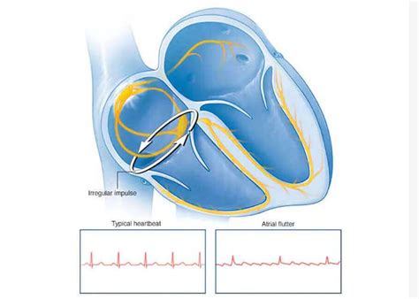 Best Atrial Flutter Treatment In Hyderabad Drsudheer