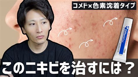 【ニキビができる場所別】原因と治療方法を現役薬剤師が解説します！ Youtube