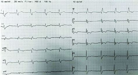 Electrocardiogram at presentation. | Download Scientific Diagram