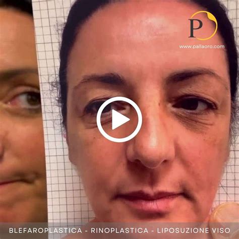 Blefaroplastica Video Pallaoro Medical Laser