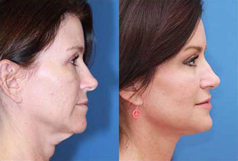 Award Winning Facelift Specialist In Scottsdale And Phoenix Az Dr