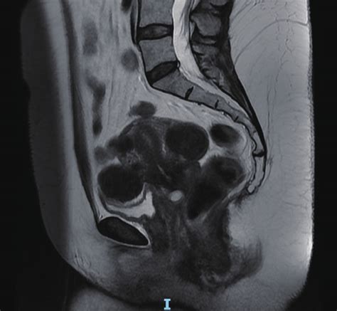 Mri Of Pelvis Mri Magnetic Resonance Imaging Download Scientific