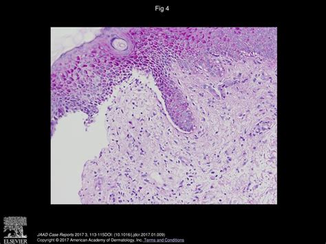 Bullous Pemphigoid Localized In A Primarily Hemiplegic Distribution Ppt Download