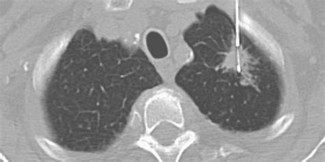 Amivantamab Plus Chemotherapy In Nsclc With Egfr Exon Insertions