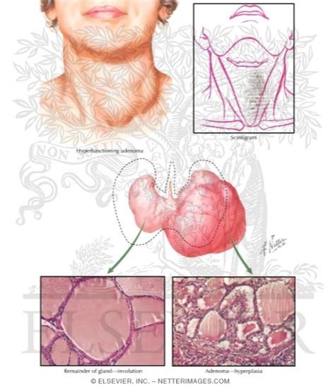 Pathophysiology Of Toxic Adenoma And Toxic Multinodular Goiter