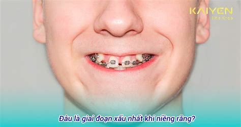 Những điều cần biết về giai đoạn xấu nhất khi niềng răng và cách chăm sóc