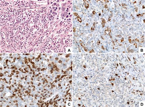 Figure 3 From The Conundrum Of The Epstein Barr Virus Associated