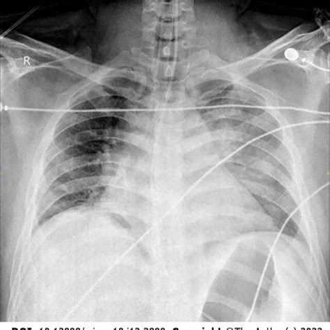 Chest X-ray. The chest X-ray revealed exudative changes in the left lung. | Download Scientific ...