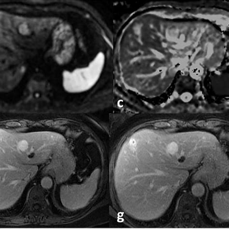 Axial T2wi A Dwi B Adc Map C T1wi D Late Arterial Phase Download Scientific Diagram