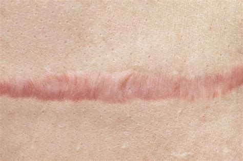 How To Reduce And Lighten Scars According To Aesthetic Experts