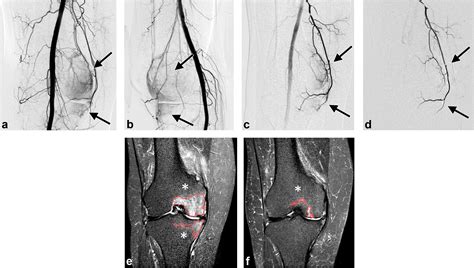 Short Term Effects Of Genicular Artery Embolization On Symptoms And