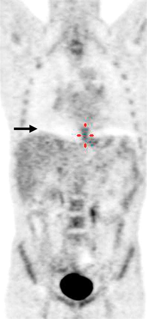 PET CT Of Esophageal Cancer Its Role In Clinical Management