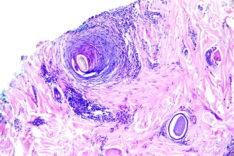 Scarring Alopecia Histology