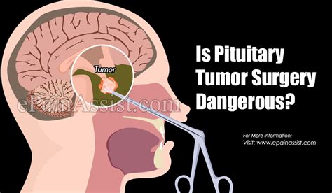 Is Pituitary Tumor Surgery Dangerous