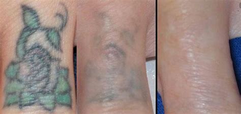 Update 56 Surgical Removal Of Tattoo In Cdgdbentre