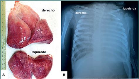 Figure From Hallazgos Similares Al Covid En Un Caso Fatal De