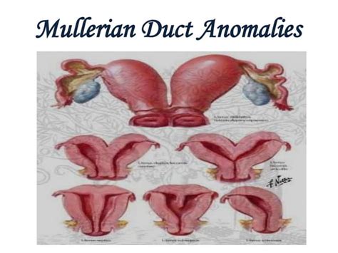 Mullerian Anomalies Ppt