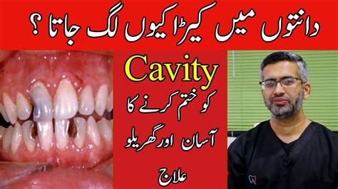 Daant Mein Keede Ka Ilaj Tooth Cavity Treatment In Urdu Hindi