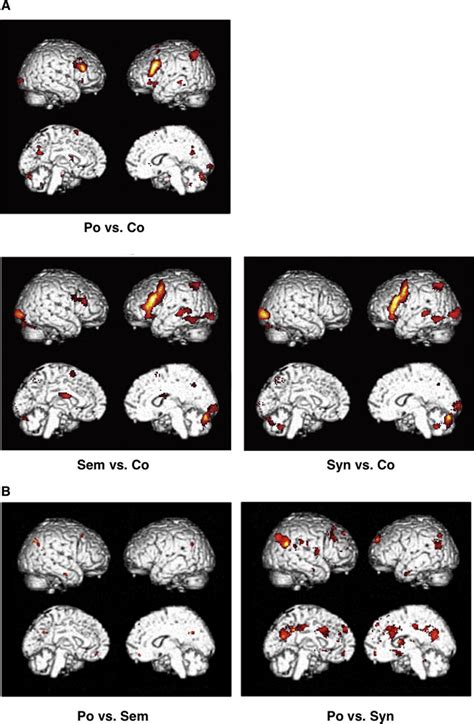 Significant FMRI Activation In Pair Wise Comparisons A The Simple