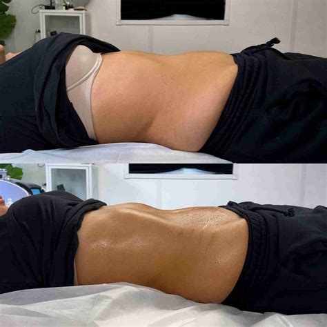 Lymphatic Drainage Massage Essex | Brazilian MLD