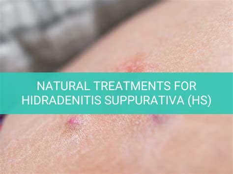 Natural Ways To Treat Hidradenitis Suppurativa Hs Houston Acupuncture