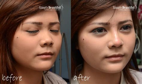 Nose Filler Injection Dr Peter Kim Surgery Skin Cancer Cosmetic