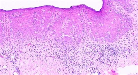 [figure Extramammary Paget Disease Contributed By Dipti Anand Md