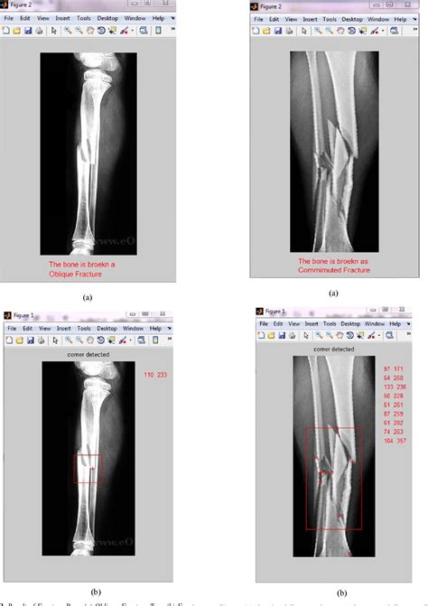 Bone Fracture Detection Using Image Processing In Matlab Code Images