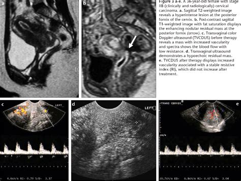 Figure 3 From Evaluation Of Radiotherapy Response Of Cervical Carcinoma