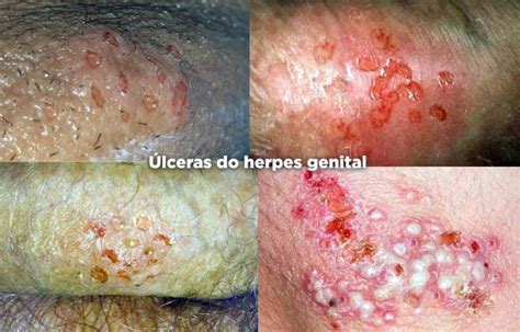 Fotos Herpes Genital Em Homens