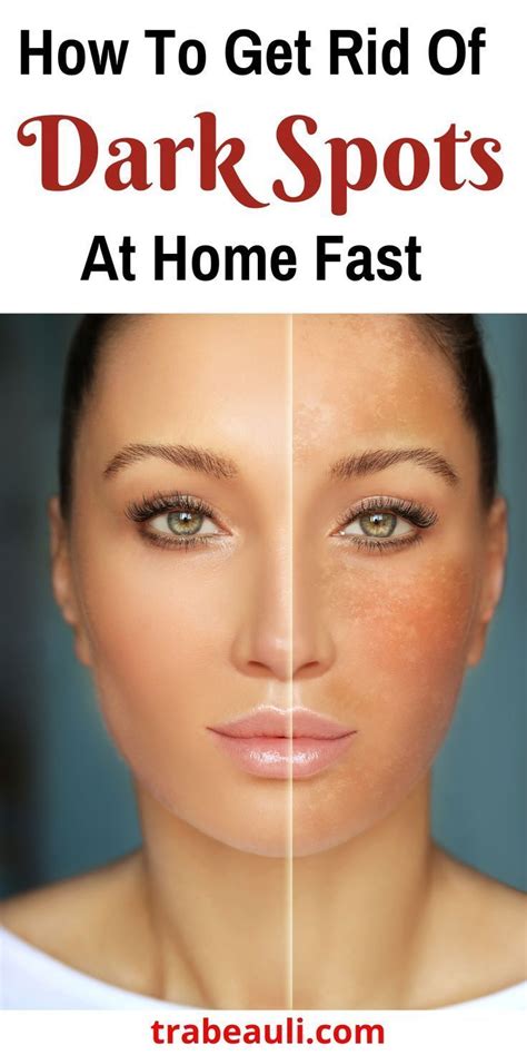 How To Get Rid Of Dark Spots At Home Fast Dark Spots On Face Dark