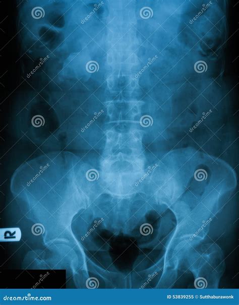 X Ray Image Of Plain Kub Stock Image Image Of Chronic 53839255