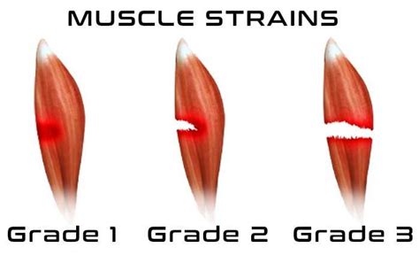 Calf Muscles And Injuries