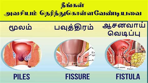 மூலம் ஆசனவாய் வெடிப்பு பவுத்திரம் அறிகுறிகளும் தீர்வும் Piles Fissure And Fistula Youtube