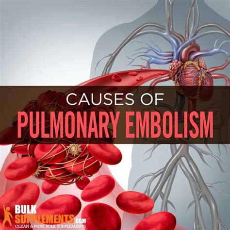 Pulmonary Embolism Causes Symptoms And Treatment