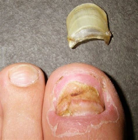 Toenail Falling Off Symptoms Causes And Treatment 2018 Updated